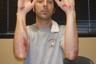 This is the majority of my wounds, luckily.